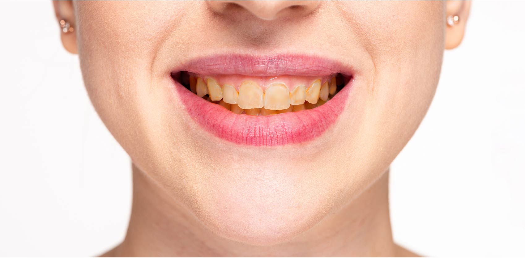 teeth-whitening-before